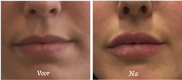 lippen dreamclinics